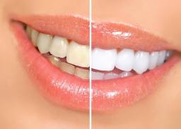 Brilliant smile косметическое отбеливание зубов