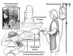 Ирригоскопия. Обследование толстого кишечника