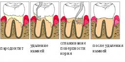 Кюретаж десневых карманов