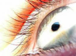 Методика лазерной коррекции зрения ЛАСИК / LASIK