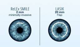 Методика лазерной коррекции зрения Relex Smile (Релекс смайл