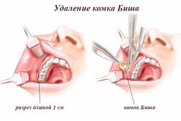 Удаление комков Биша