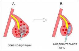 Ультразвуковая дезинтеграция нижних носовых раковин