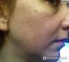 Фото 4 - Биоревитализация препаратом Beautypharma (Бьютифарма) Hyal-Amin Фото 4
