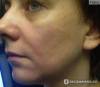 Фото 3 - Биоревитализация препаратом Beautypharma (Бьютифарма) Hyal-Amin Фото 3