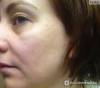 Фото 6 - Биоревитализация препаратом Beautypharma (Бьютифарма) Hyal-Amin Фото 6
