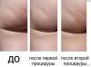 Фото 1 - Салонная процедура Lipo-Stock extreme (Липосток) от Germaine de Capuccini Фото 1